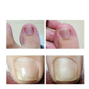 Adesivo NailFREE™ - Elimina Fungos e Bactérias e Desencrava as Unhas (Ultimas Unidades)